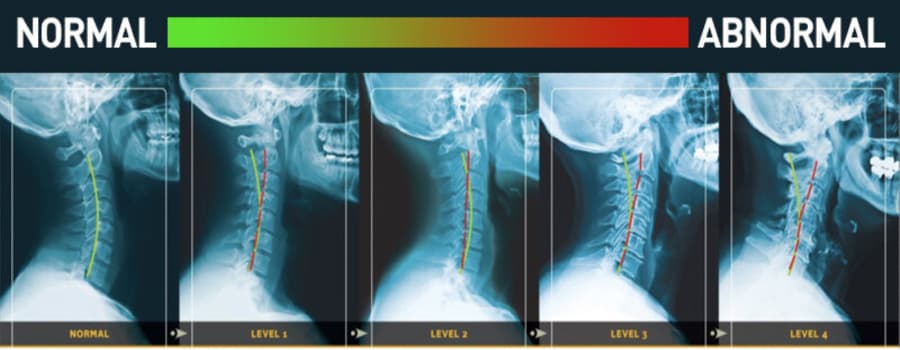 Graphic of multiple X-rays showing postural dysfunction.